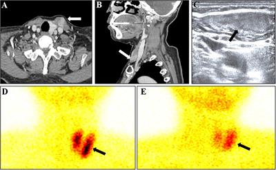 Ectopic parathyroid adenoma on sternocleidomastoid muscle: a case report